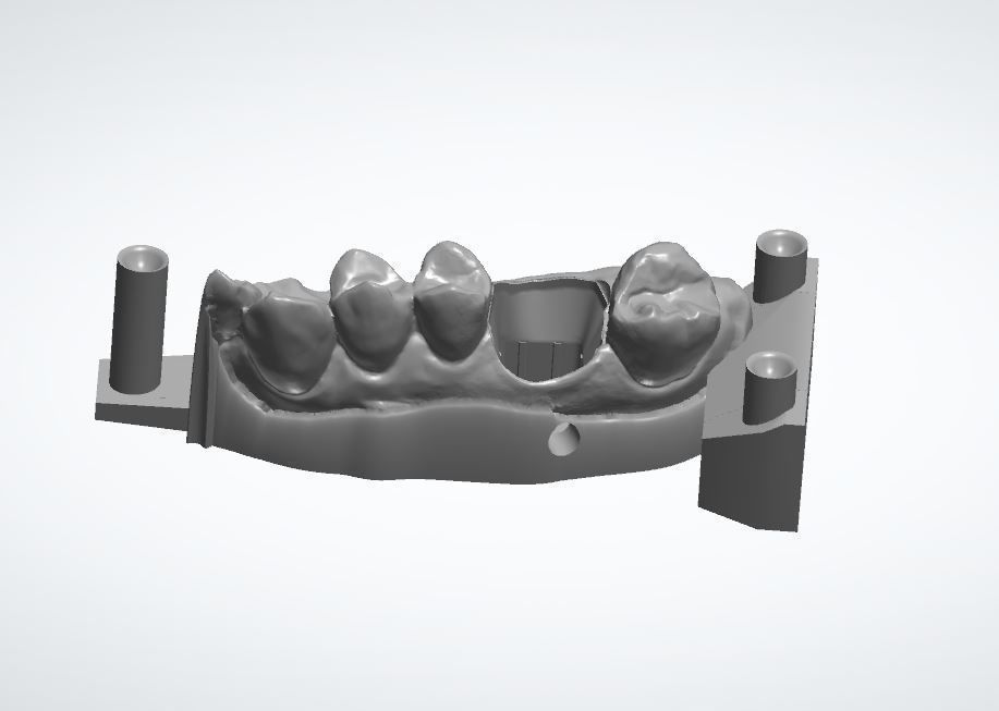 Teeth model dental implant Free 3D model_1