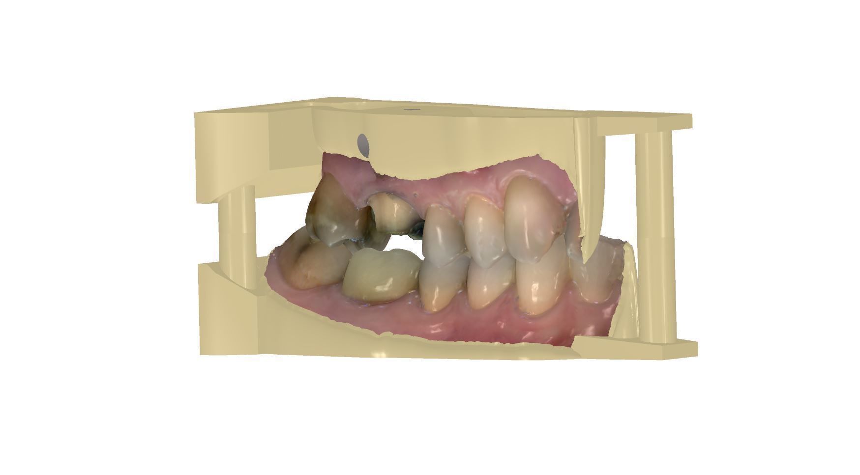 Teeth model dental implant Free 3D model_3