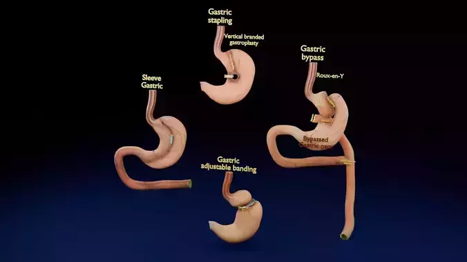 Bariatric Surgery Types Low-poly 3D model