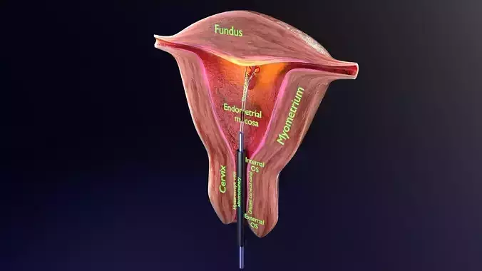Endometrial Polyp Electrocautery