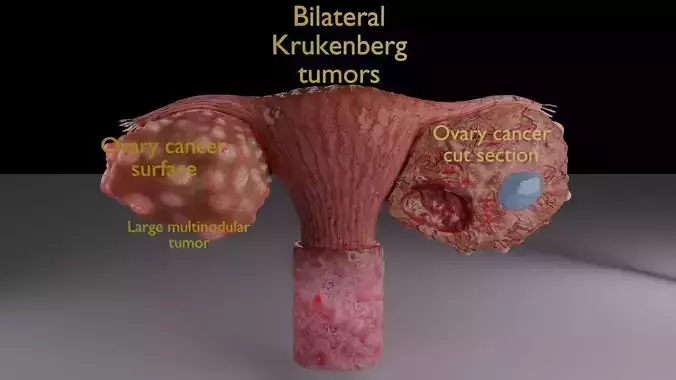 Krukenberg ovarian cancer tumor 