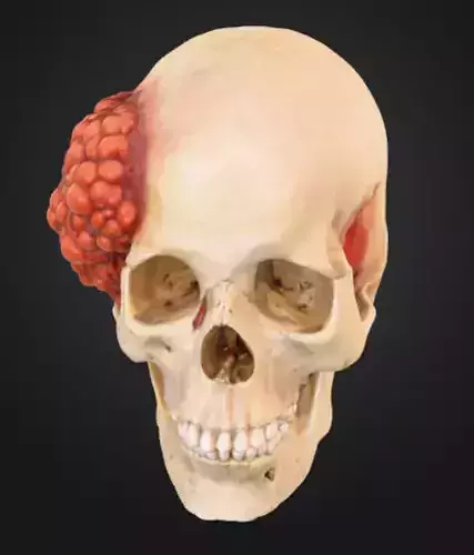 Human Skull with Bone Cancer Tumor Low-poly 3D model
