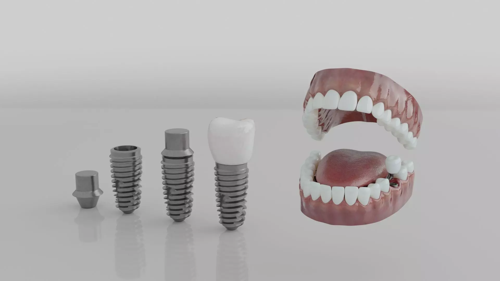 Full Realistic Tooth Implants Render Ready High Quality Model 3D model