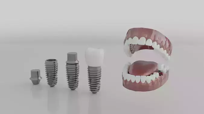 Full Realistic Tooth Implants Render Ready High Quality Model 