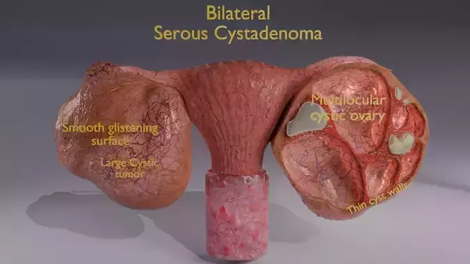 Ovary tumor benign non-cancerous serous cystadenoma  