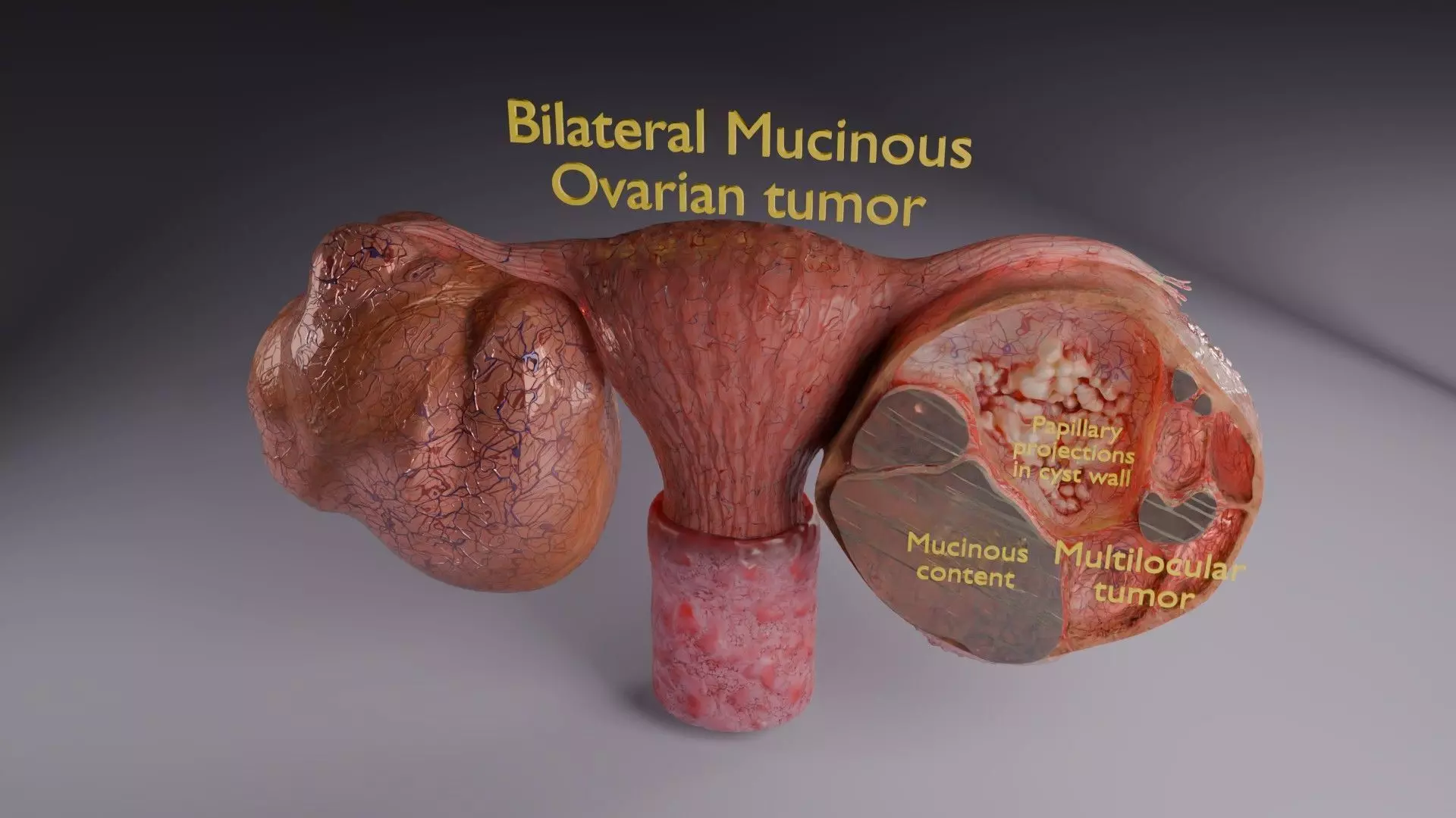 ovary mucinous cystic tumor  Low-poly 3D model_72