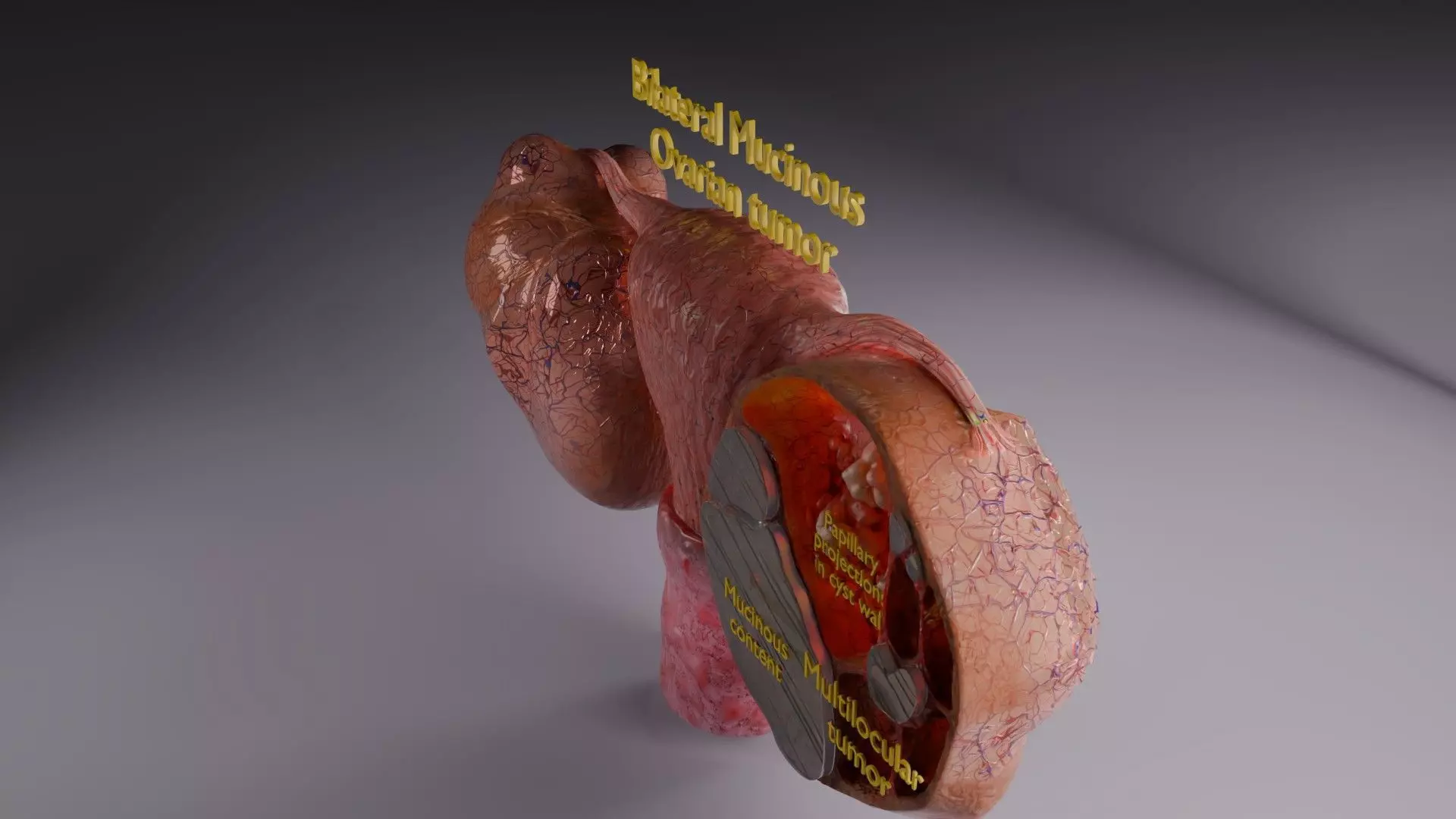 ovary mucinous cystic tumor  Low-poly 3D model_64