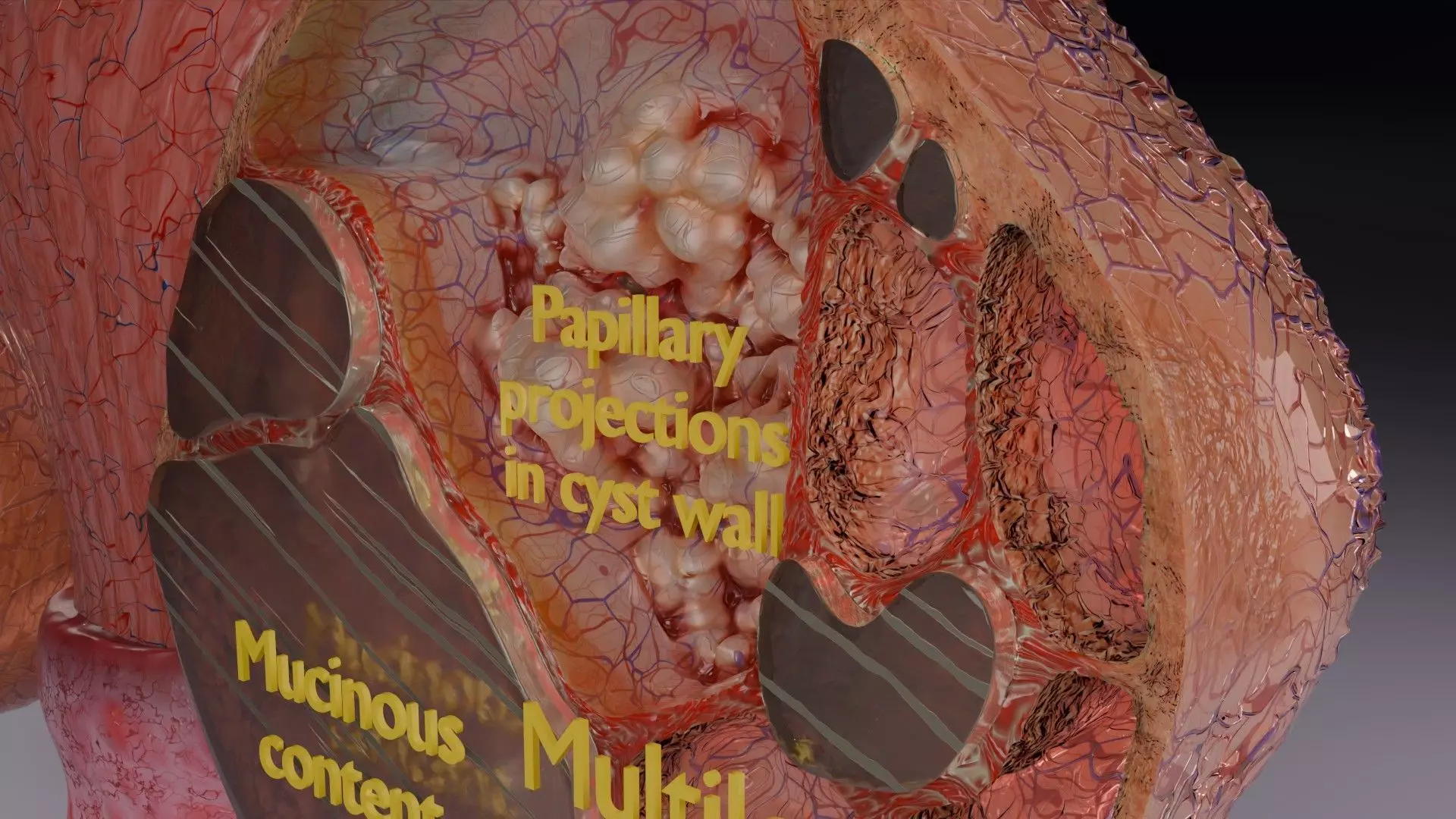 ovary mucinous cystic tumor  Low-poly 3D model_10