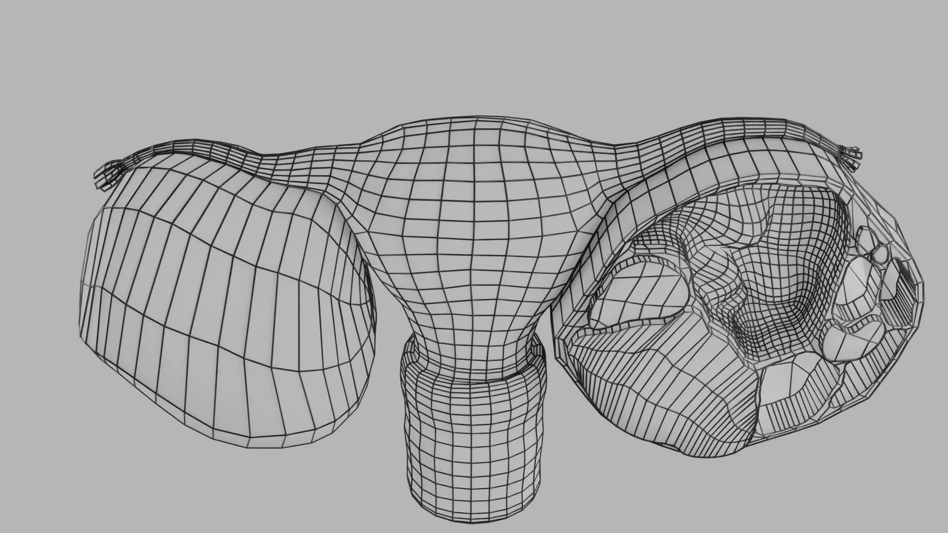 ovary mucinous cystic tumor  Low-poly 3D model_39