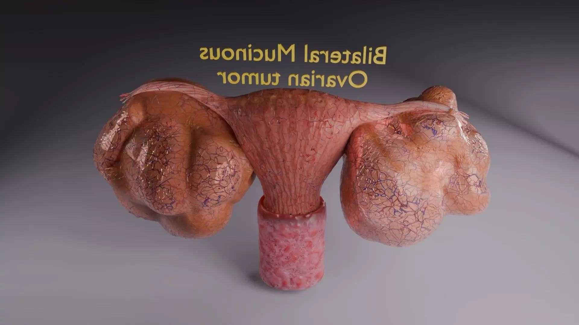 ovary mucinous cystic tumor  Low-poly 3D model_74