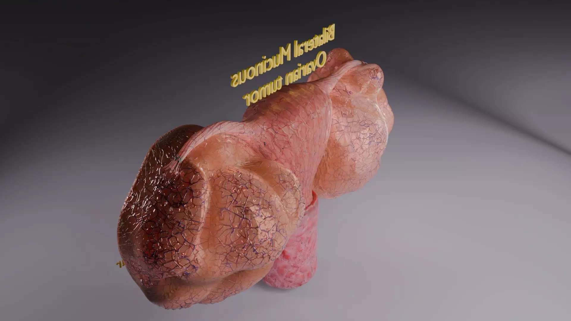 ovary mucinous cystic tumor  Low-poly 3D model_62