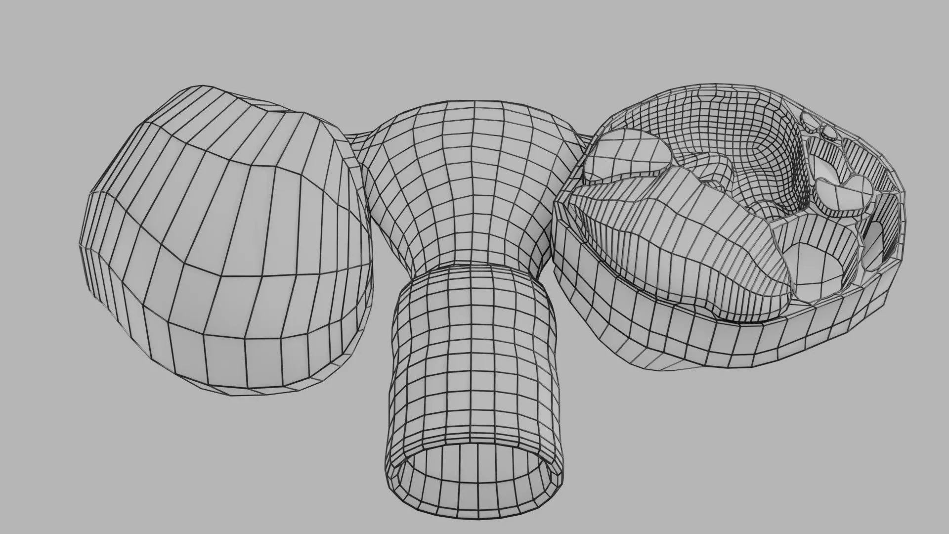 ovary mucinous cystic tumor  Low-poly 3D model_40