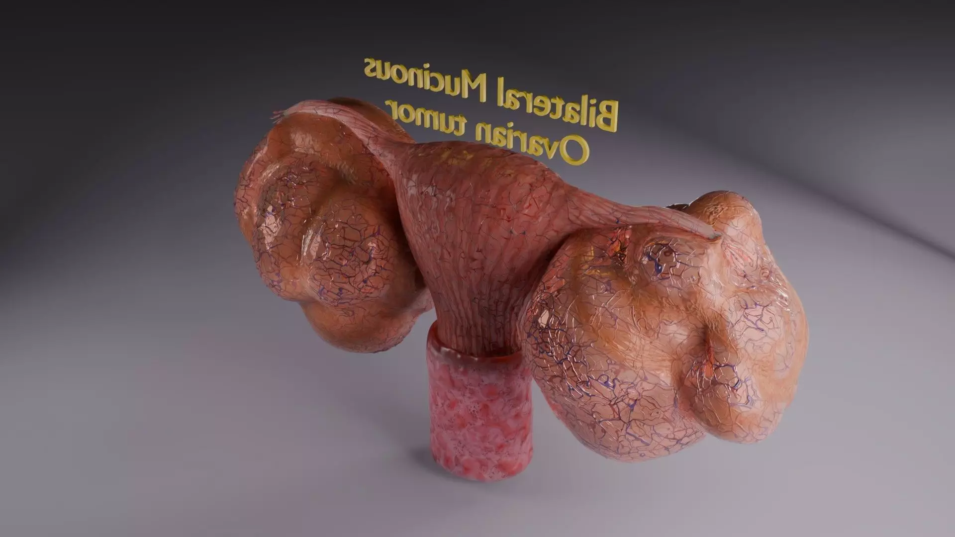 ovary mucinous cystic tumor  Low-poly 3D model_69