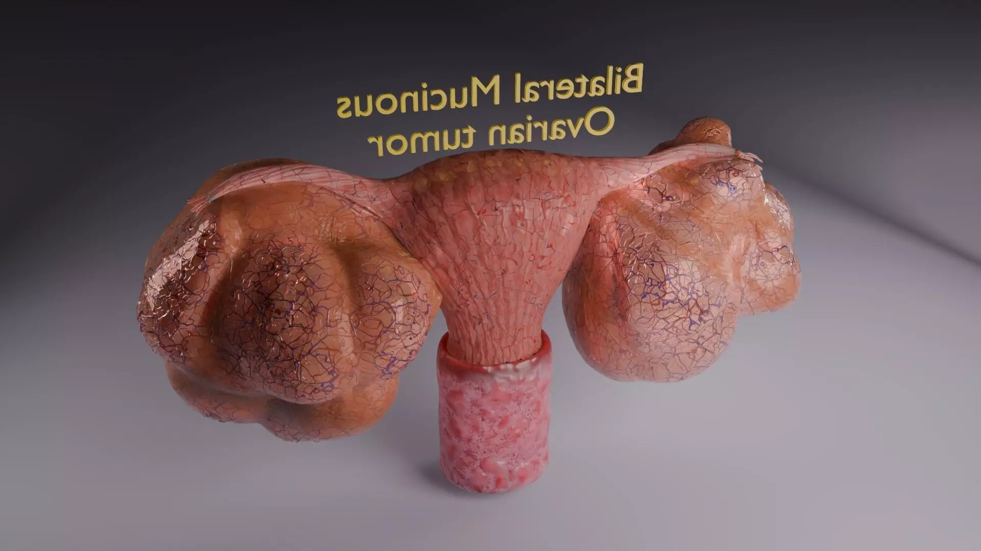 ovary mucinous cystic tumor  Low-poly 3D model_63