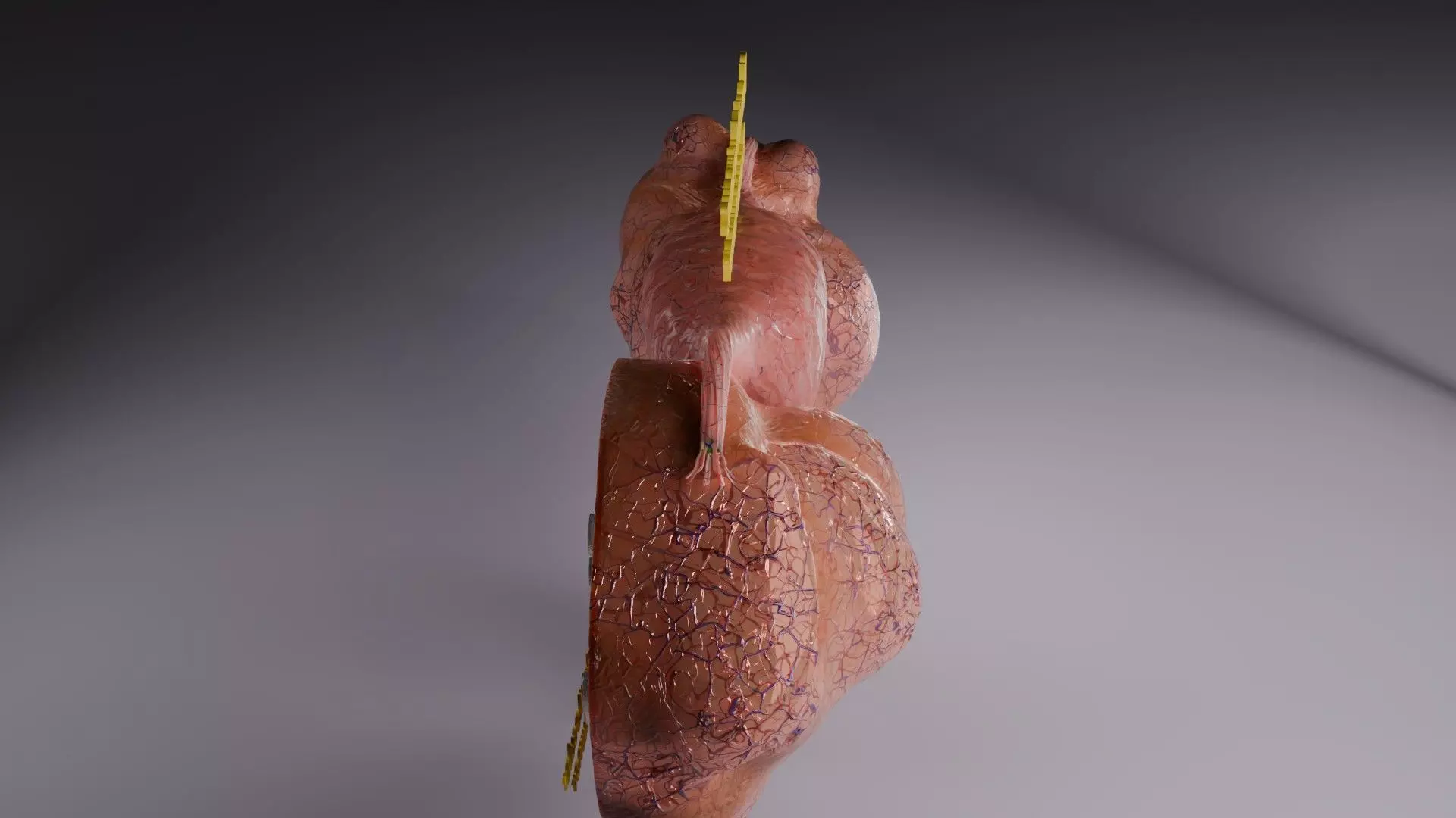 ovary mucinous cystic tumor  Low-poly 3D model_68