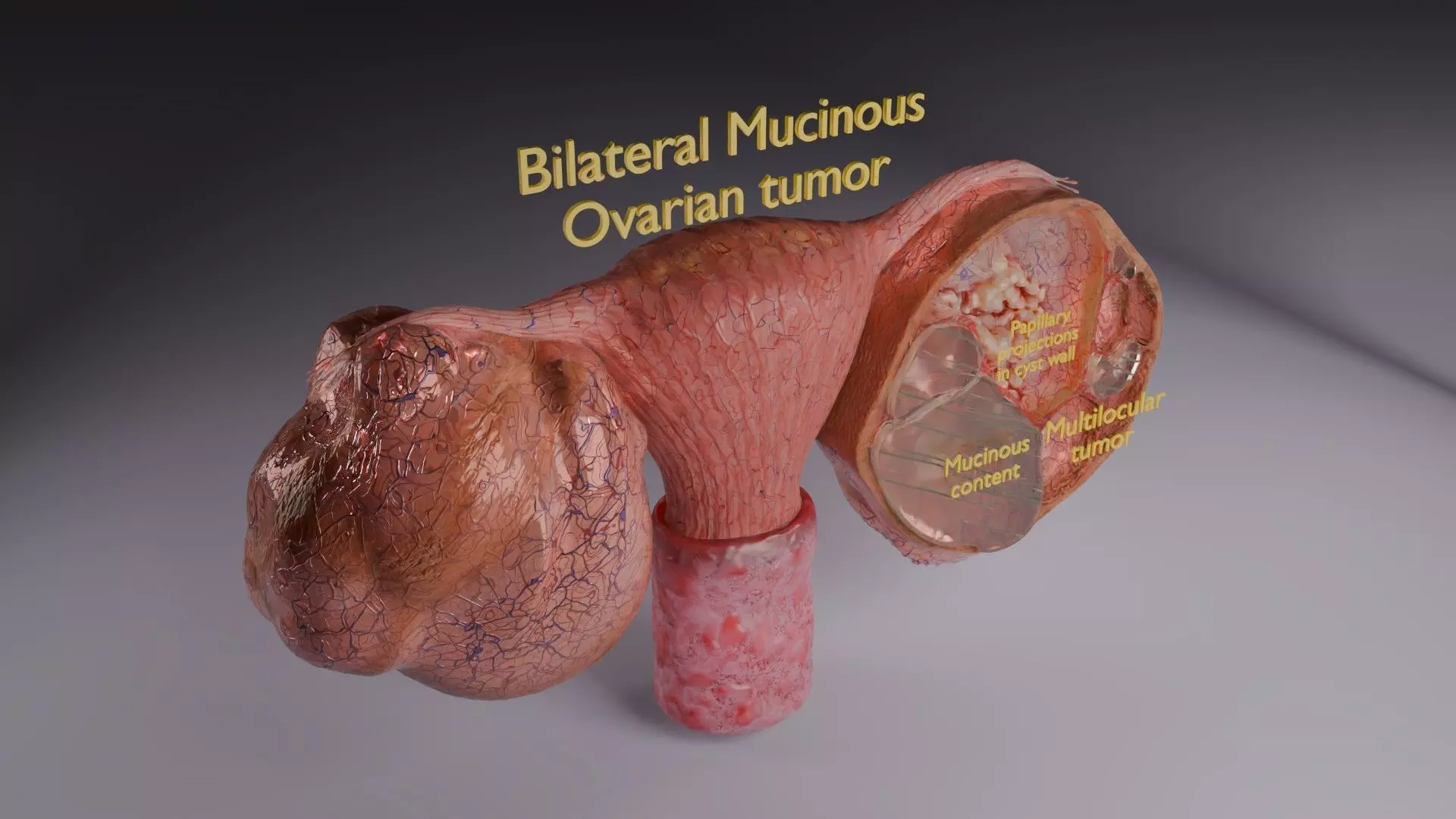 ovary mucinous cystic tumor  Low-poly 3D model_42