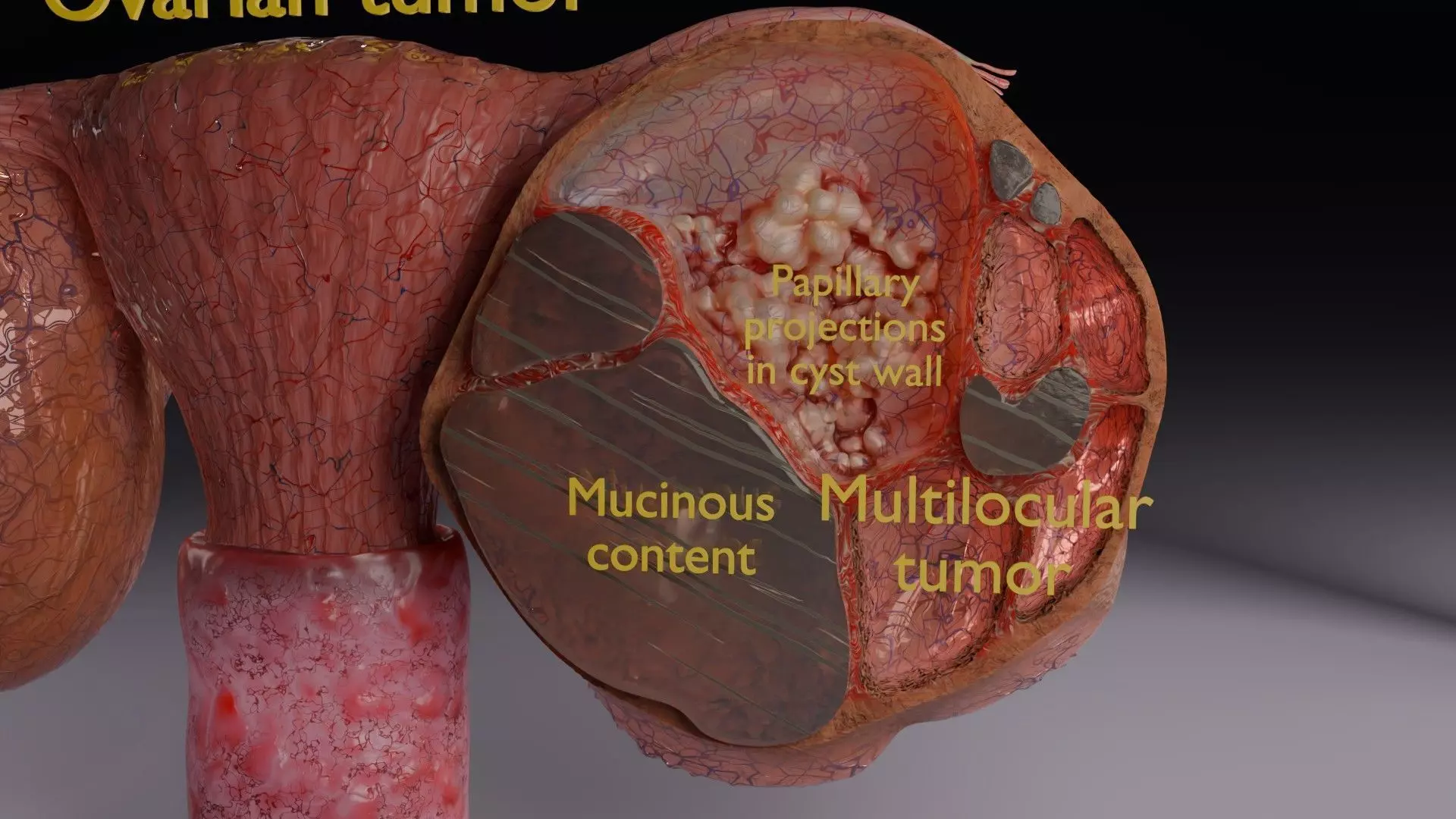 ovary mucinous cystic tumor  Low-poly 3D model_3