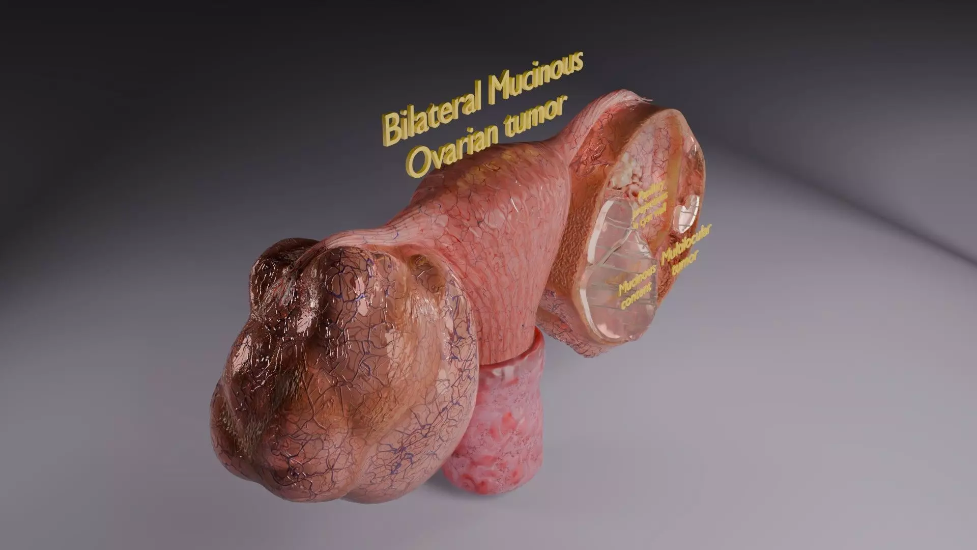 ovary mucinous cystic tumor  Low-poly 3D model_49