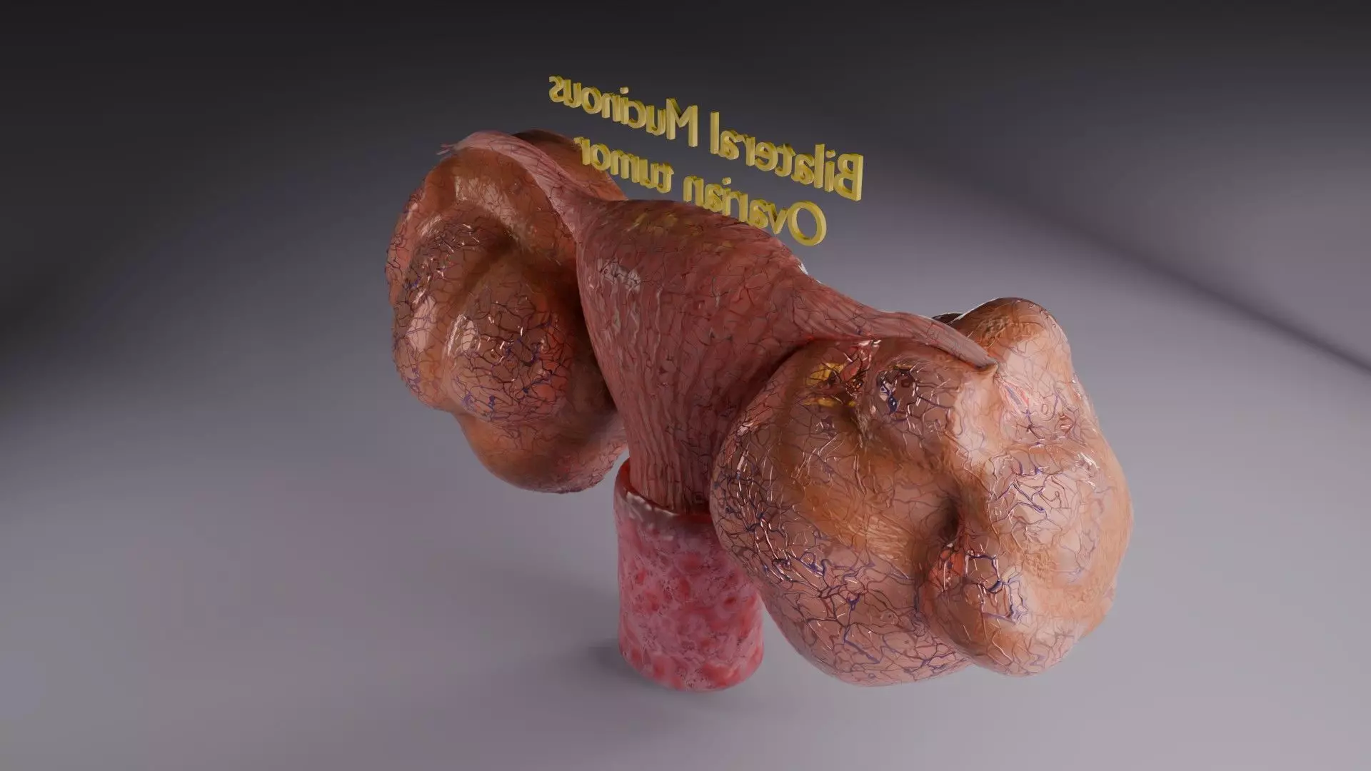 ovary mucinous cystic tumor  Low-poly 3D model_55