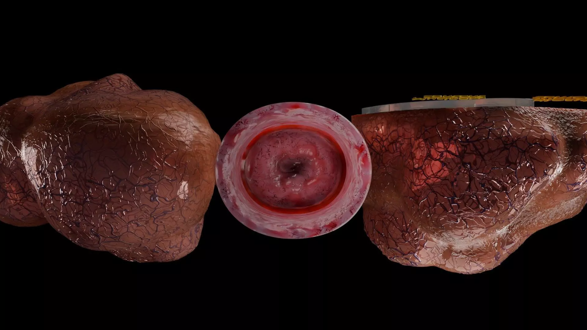 ovary mucinous cystic tumor  Low-poly 3D model_18