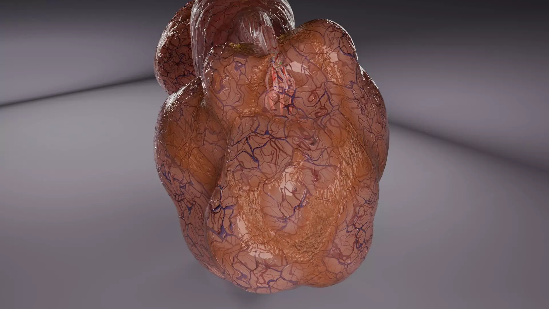 ovary mucinous cystic tumor  Low-poly 3D model_2