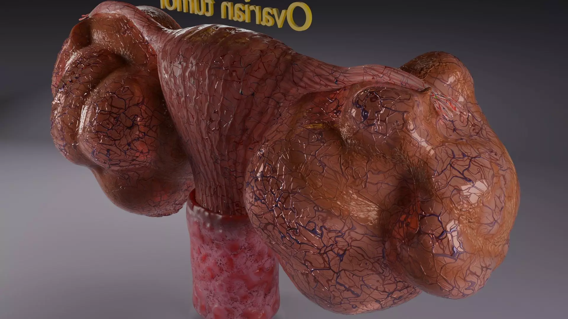 ovary mucinous cystic tumor  Low-poly 3D model_4