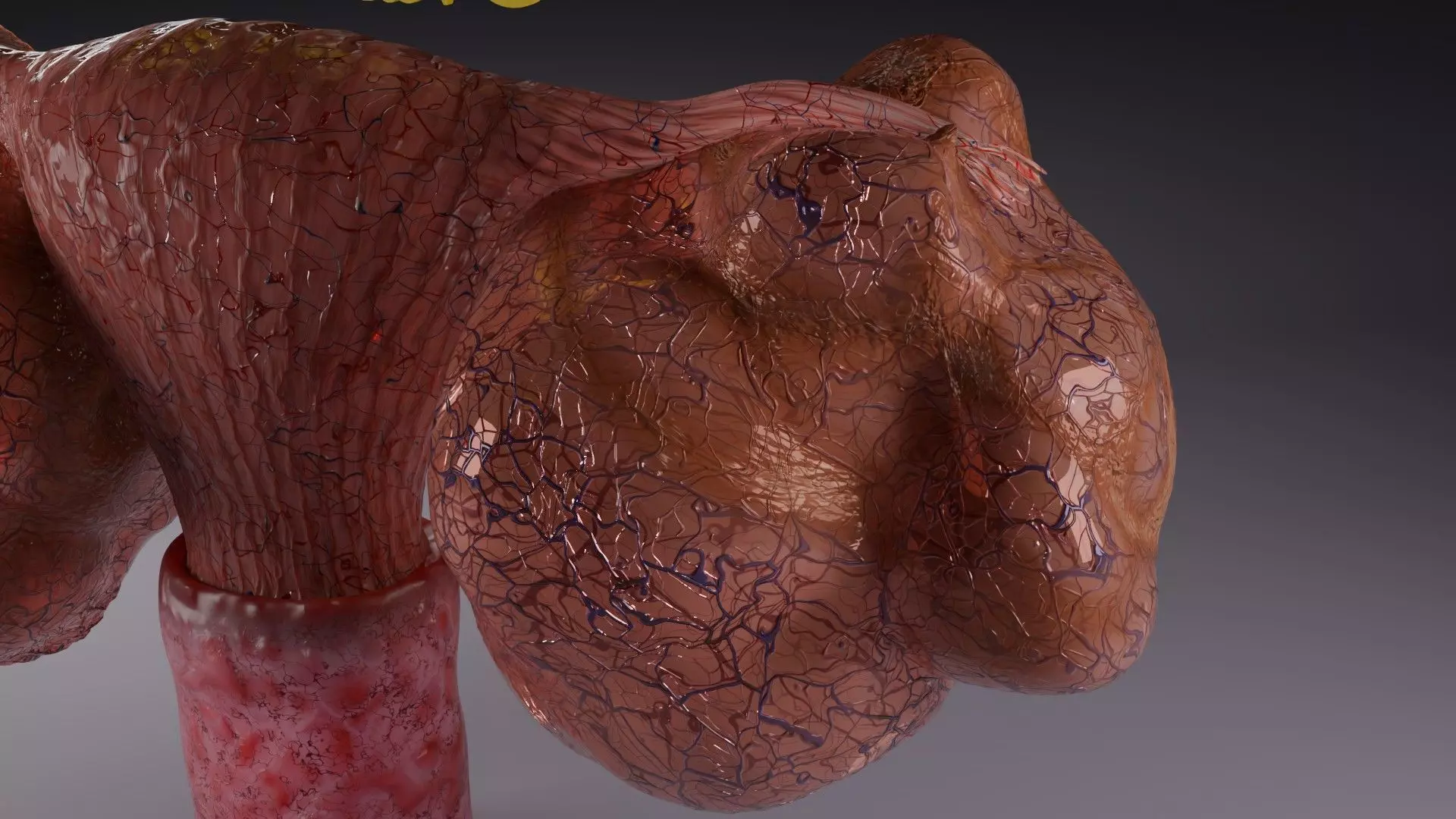 ovary mucinous cystic tumor  Low-poly 3D model_11