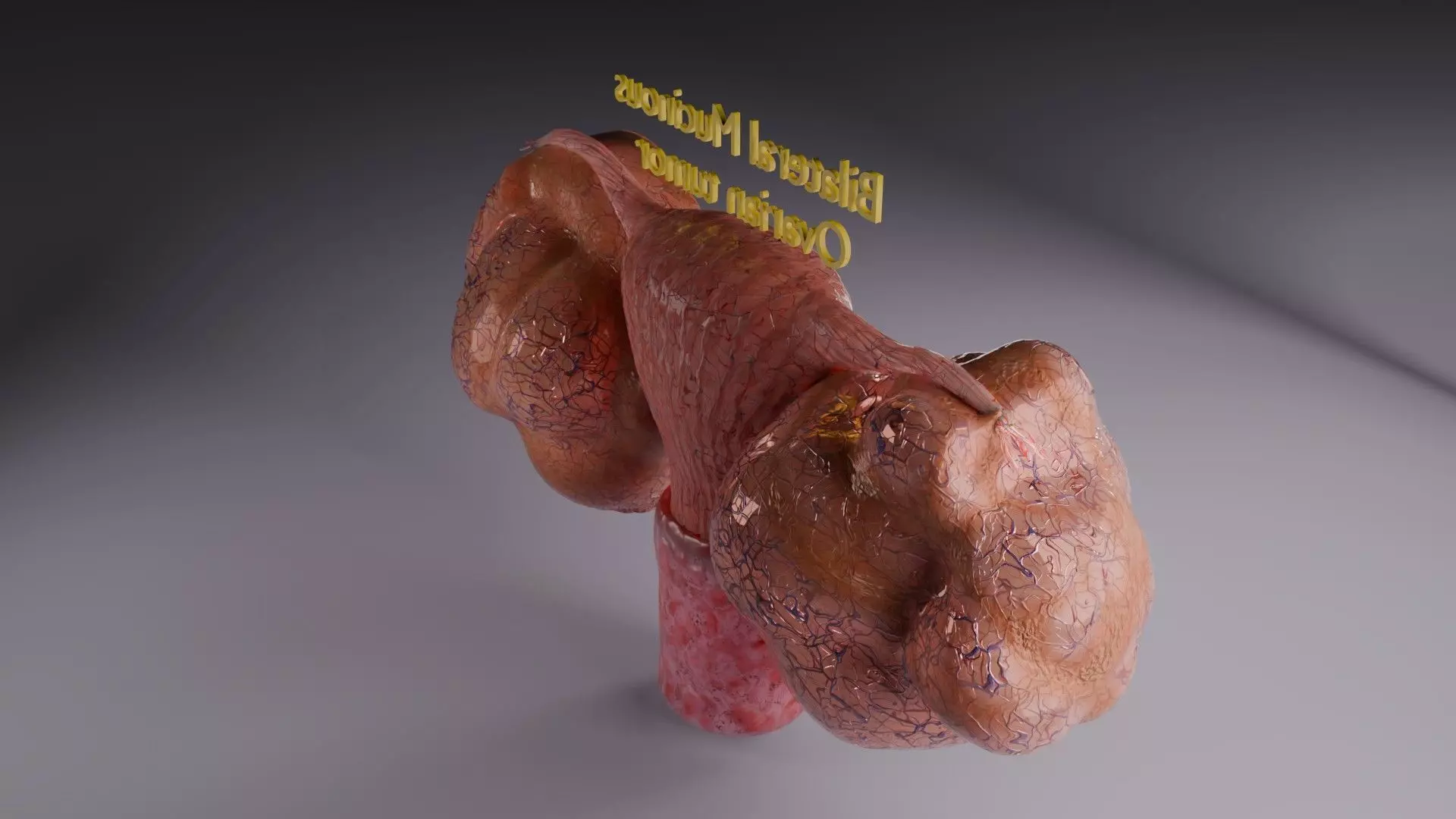 ovary mucinous cystic tumor  Low-poly 3D model_47