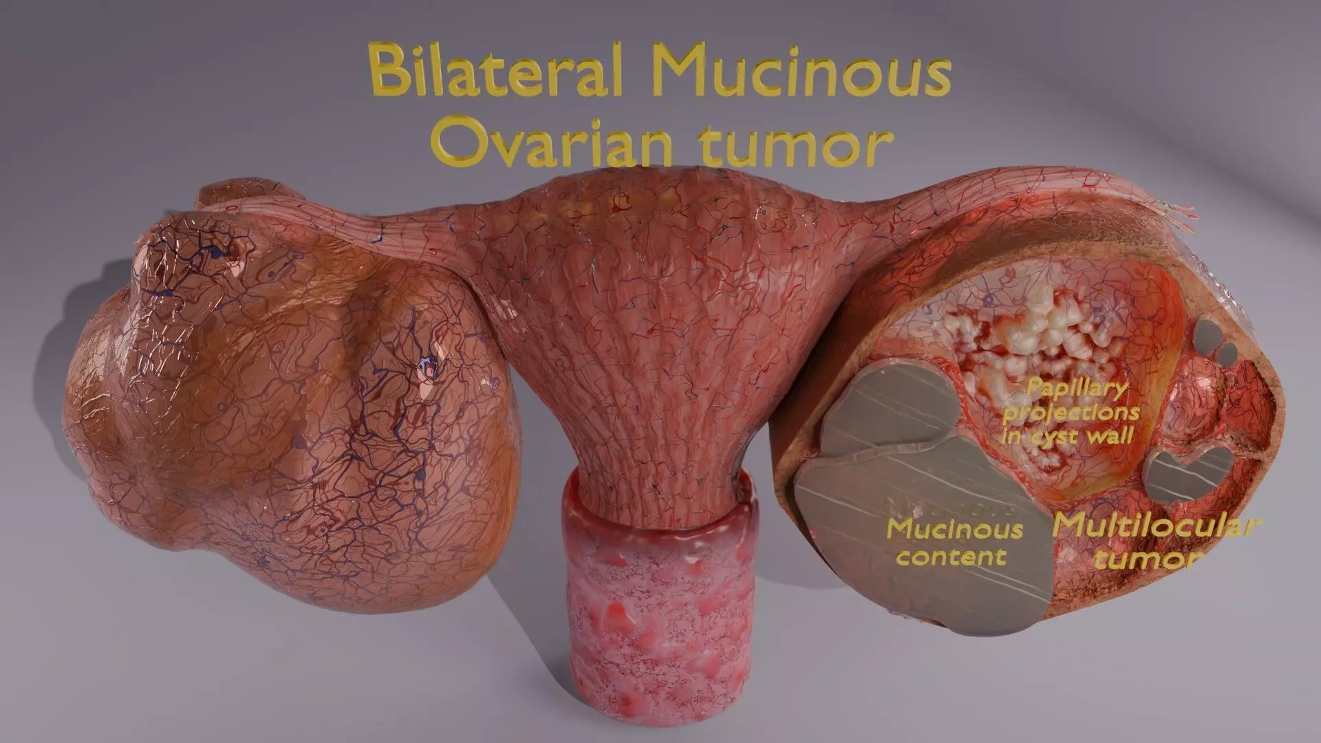 ovary mucinous cystic tumor  Low-poly 3D model_7