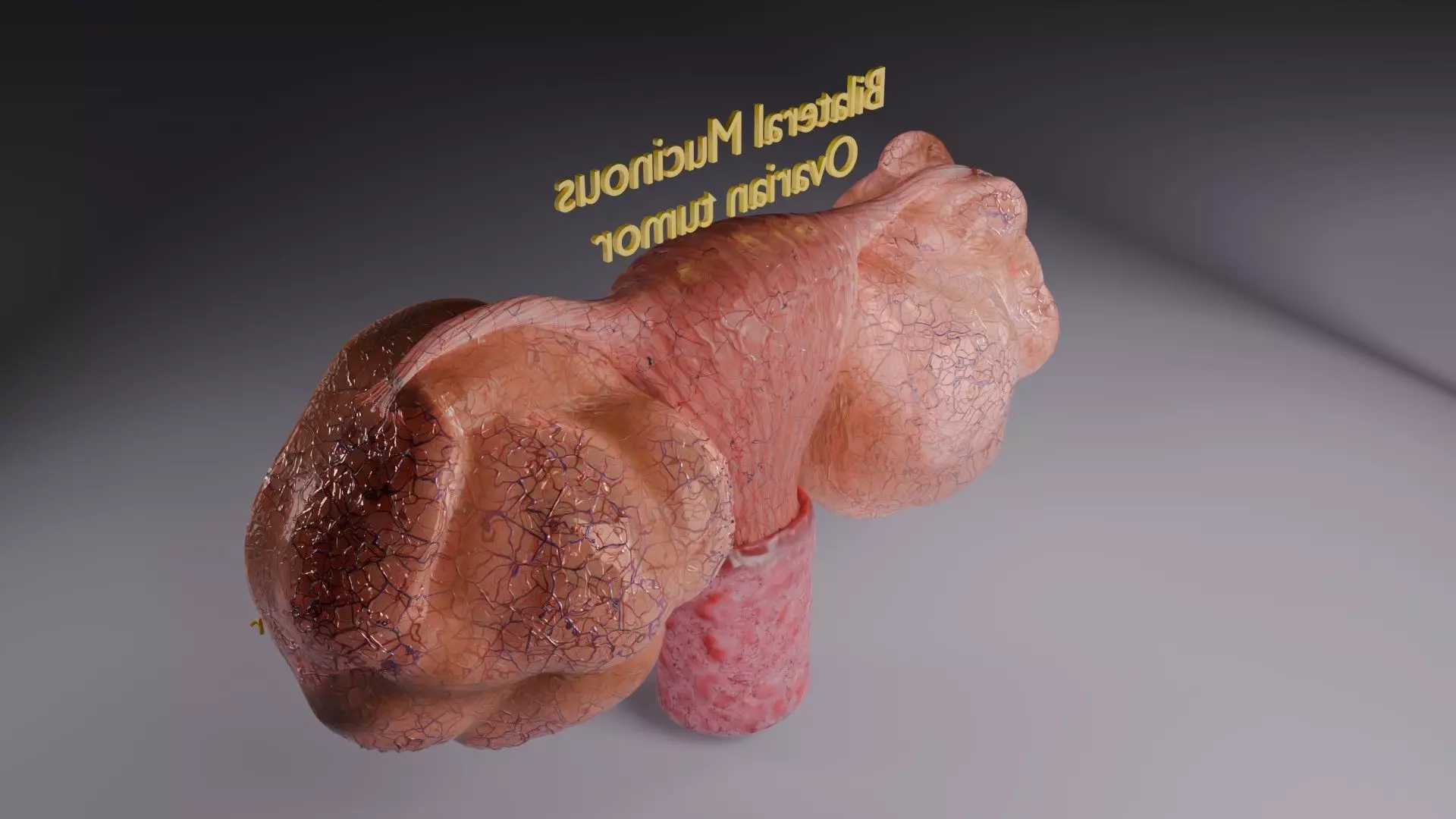 ovary mucinous cystic tumor  Low-poly 3D model_59