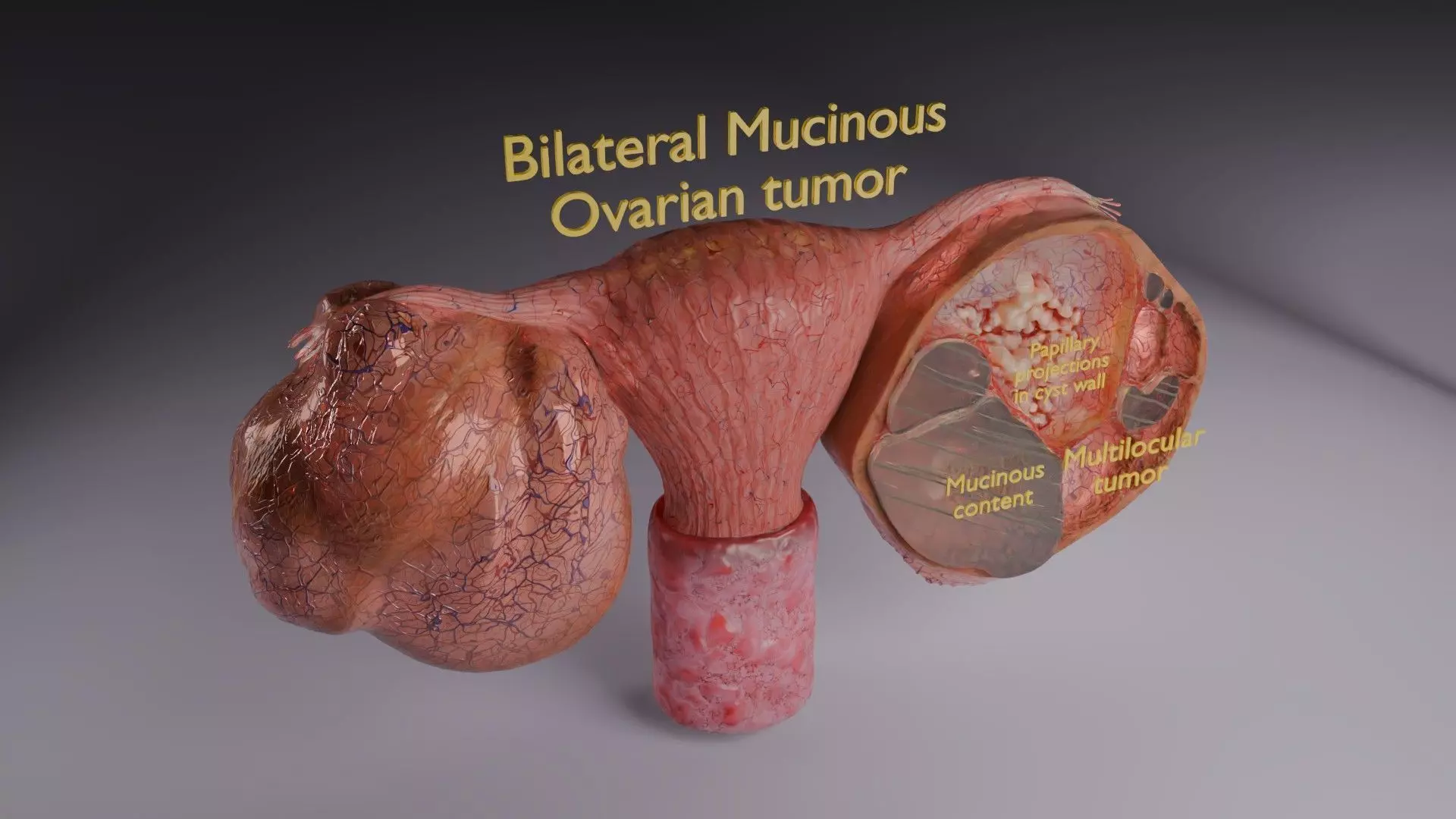 ovary mucinous cystic tumor  Low-poly 3D model_36