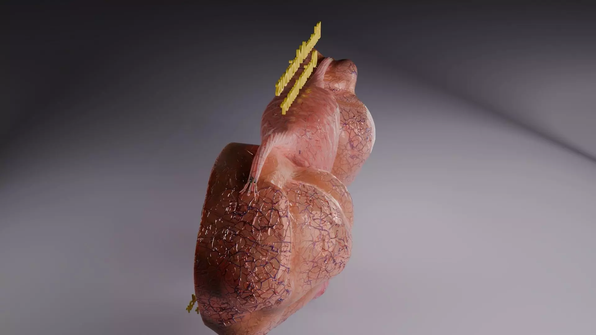 ovary mucinous cystic tumor  Low-poly 3D model_54