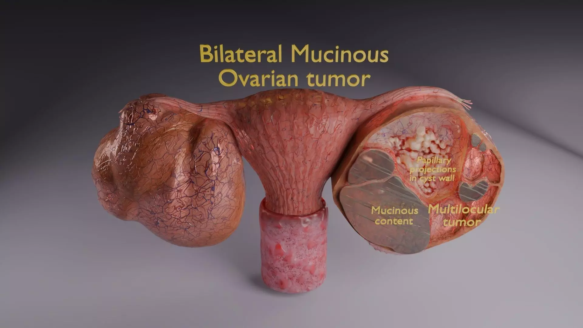 ovary mucinous cystic tumor  Low-poly 3D model_71