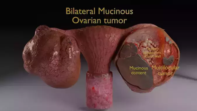 ovary mucinous cystic tumor 