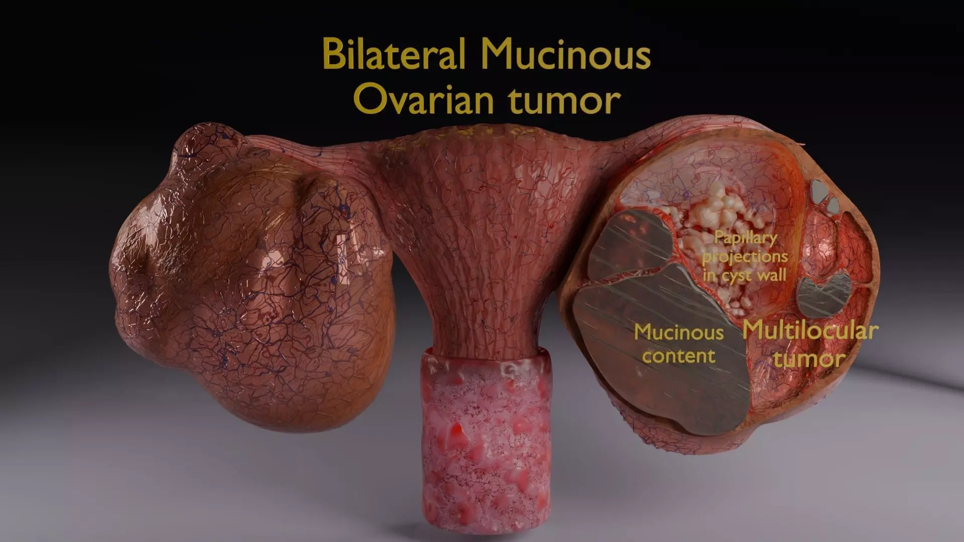 ovary mucinous cystic tumor  Low-poly 3D model_0