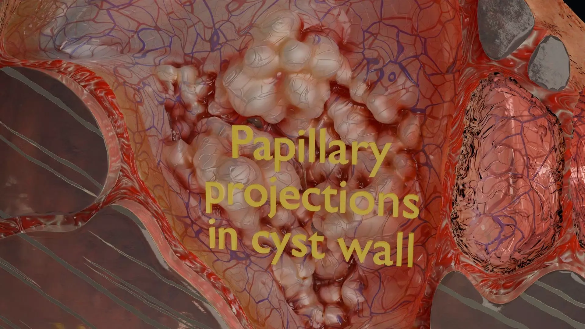 ovary mucinous cystic tumor  Low-poly 3D model_13