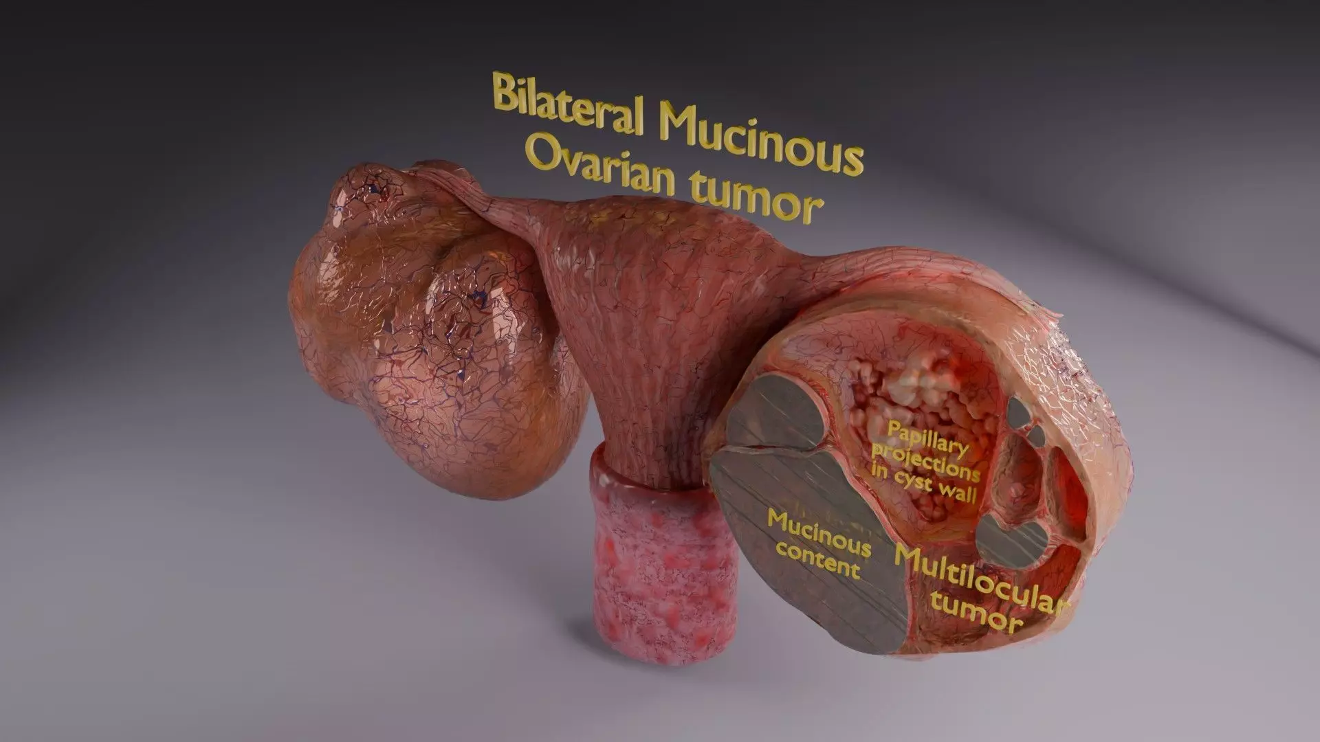 ovary mucinous cystic tumor  Low-poly 3D model_70