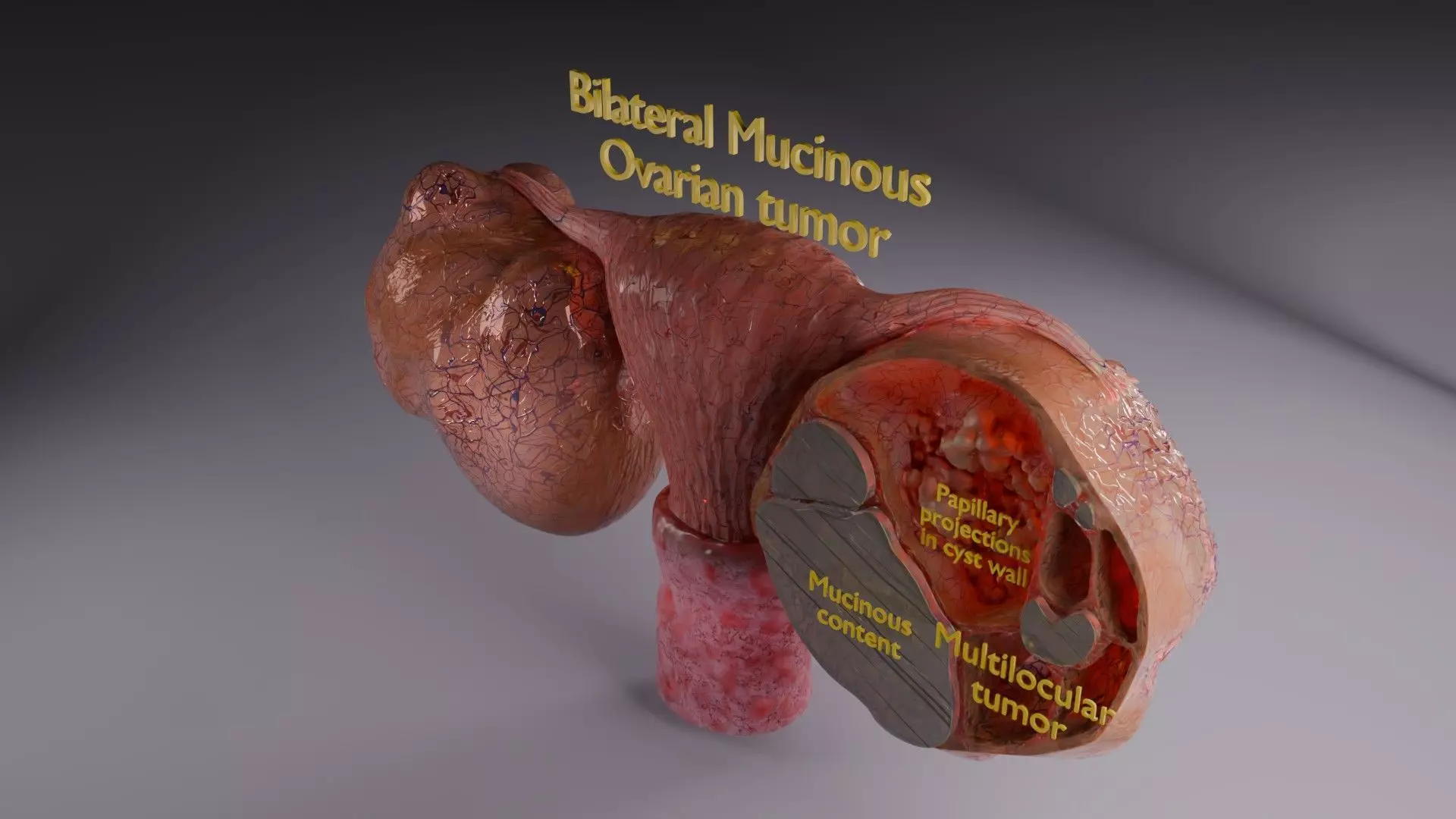 ovary mucinous cystic tumor  Low-poly 3D model_73