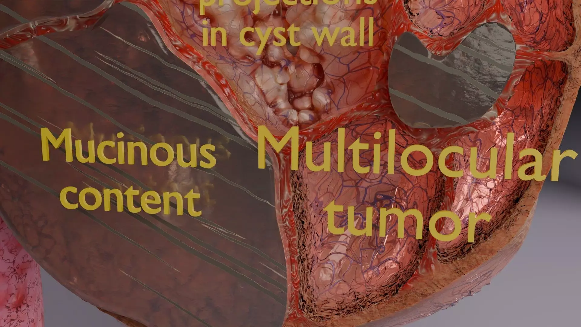 ovary mucinous cystic tumor  Low-poly 3D model_19