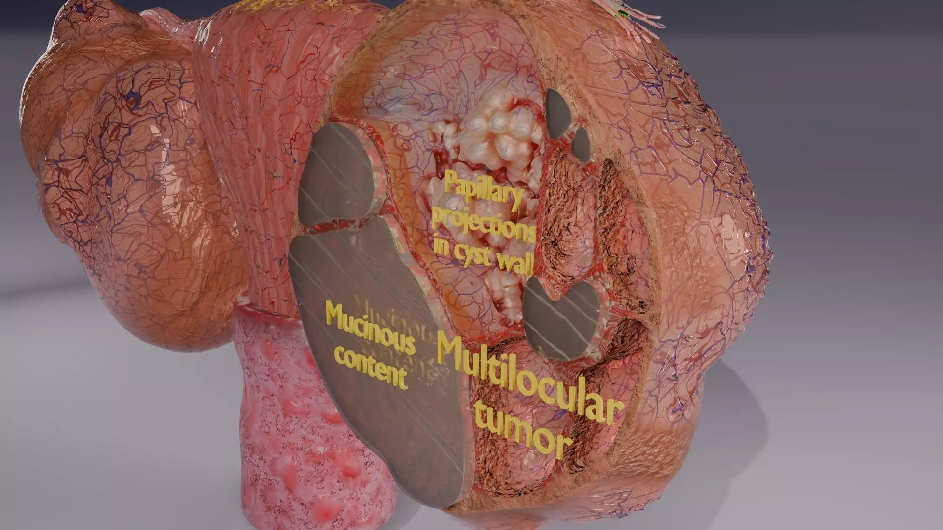 ovary mucinous cystic tumor  Low-poly 3D model_5