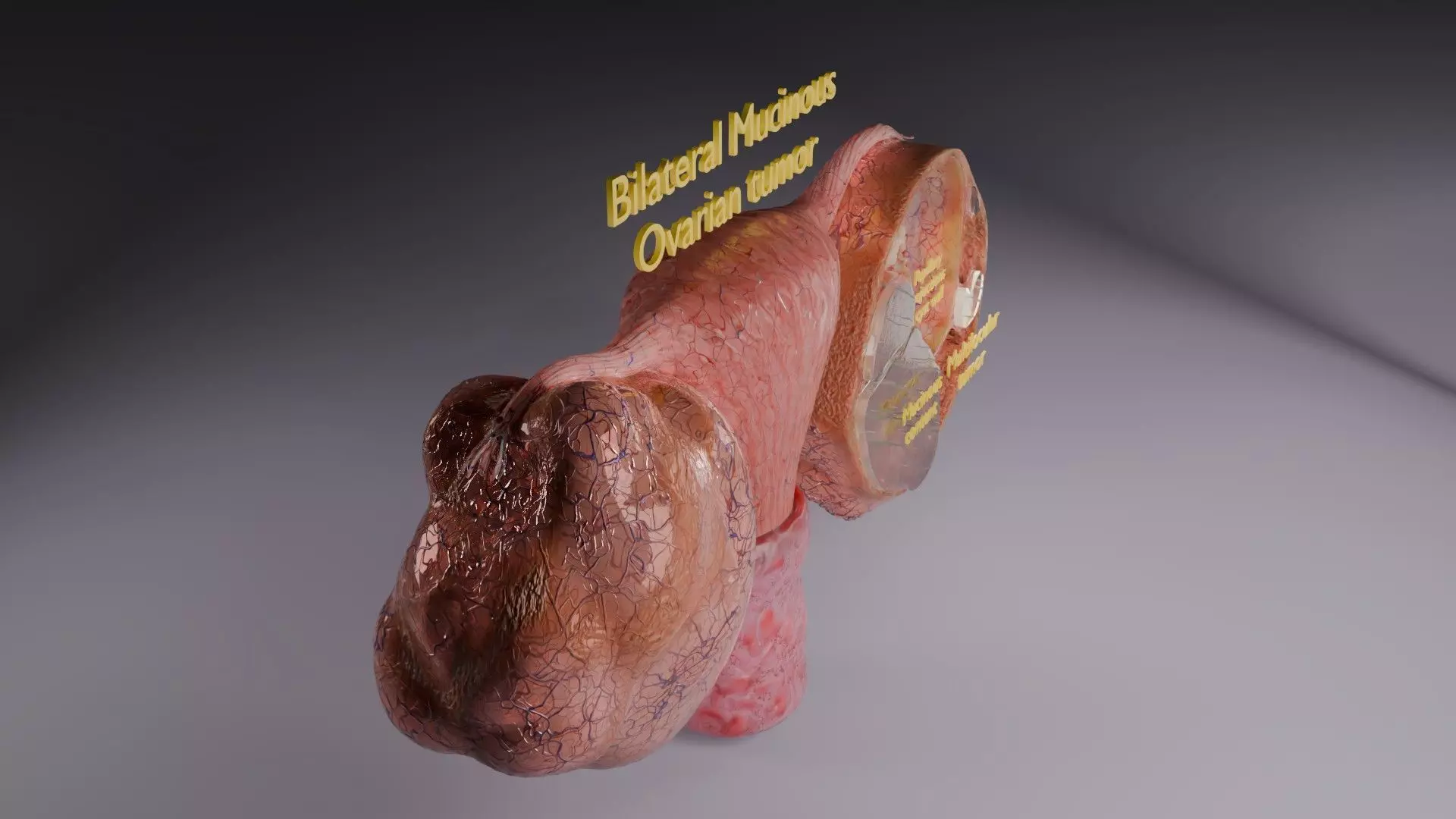 ovary mucinous cystic tumor  Low-poly 3D model_45