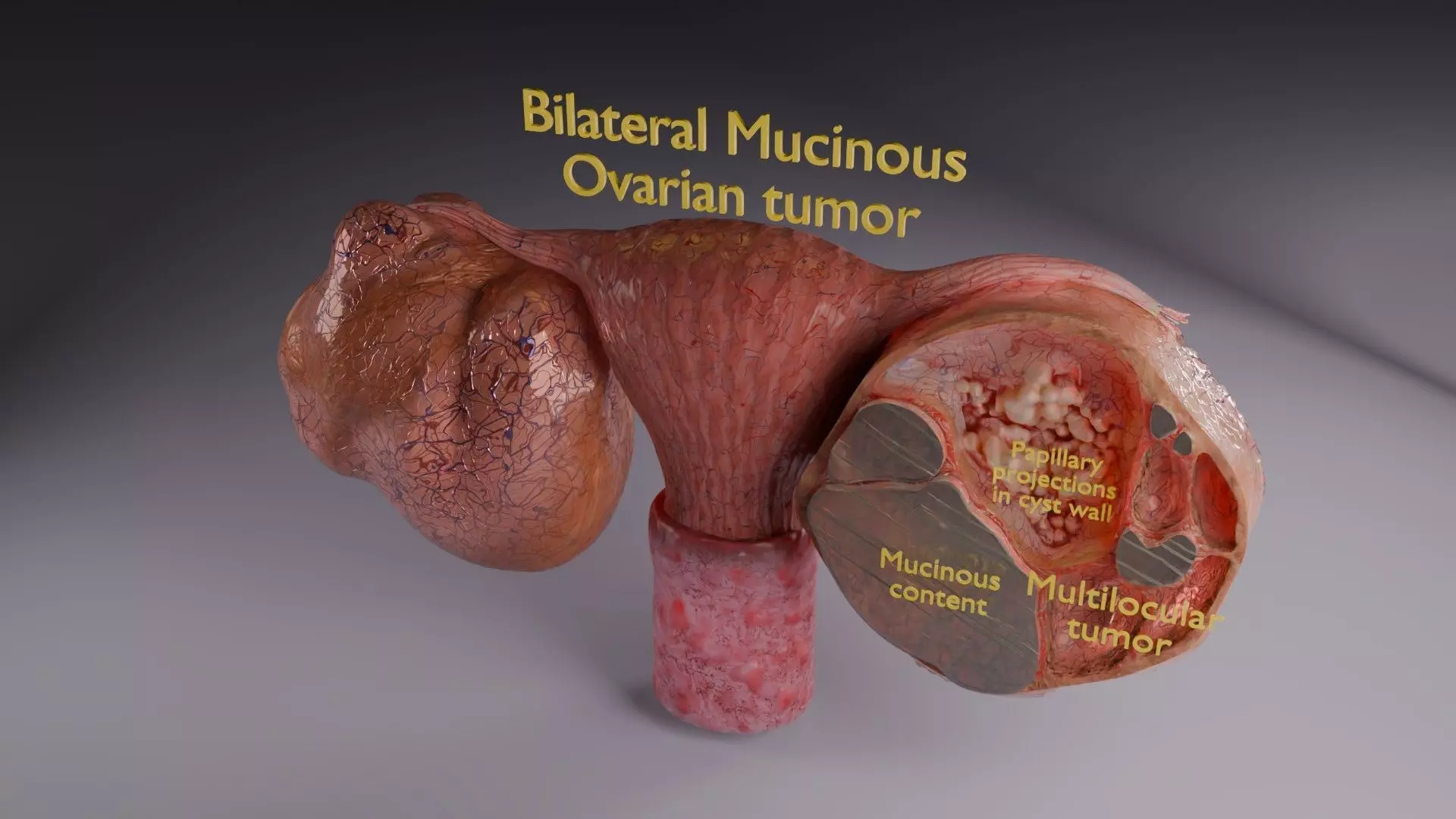 ovary mucinous cystic tumor  Low-poly 3D model_75