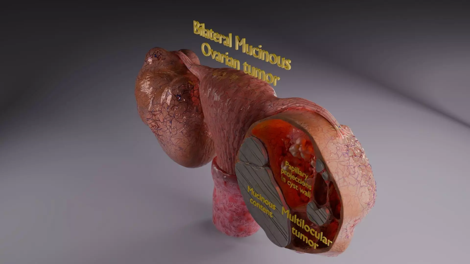 ovary mucinous cystic tumor  Low-poly 3D model_60