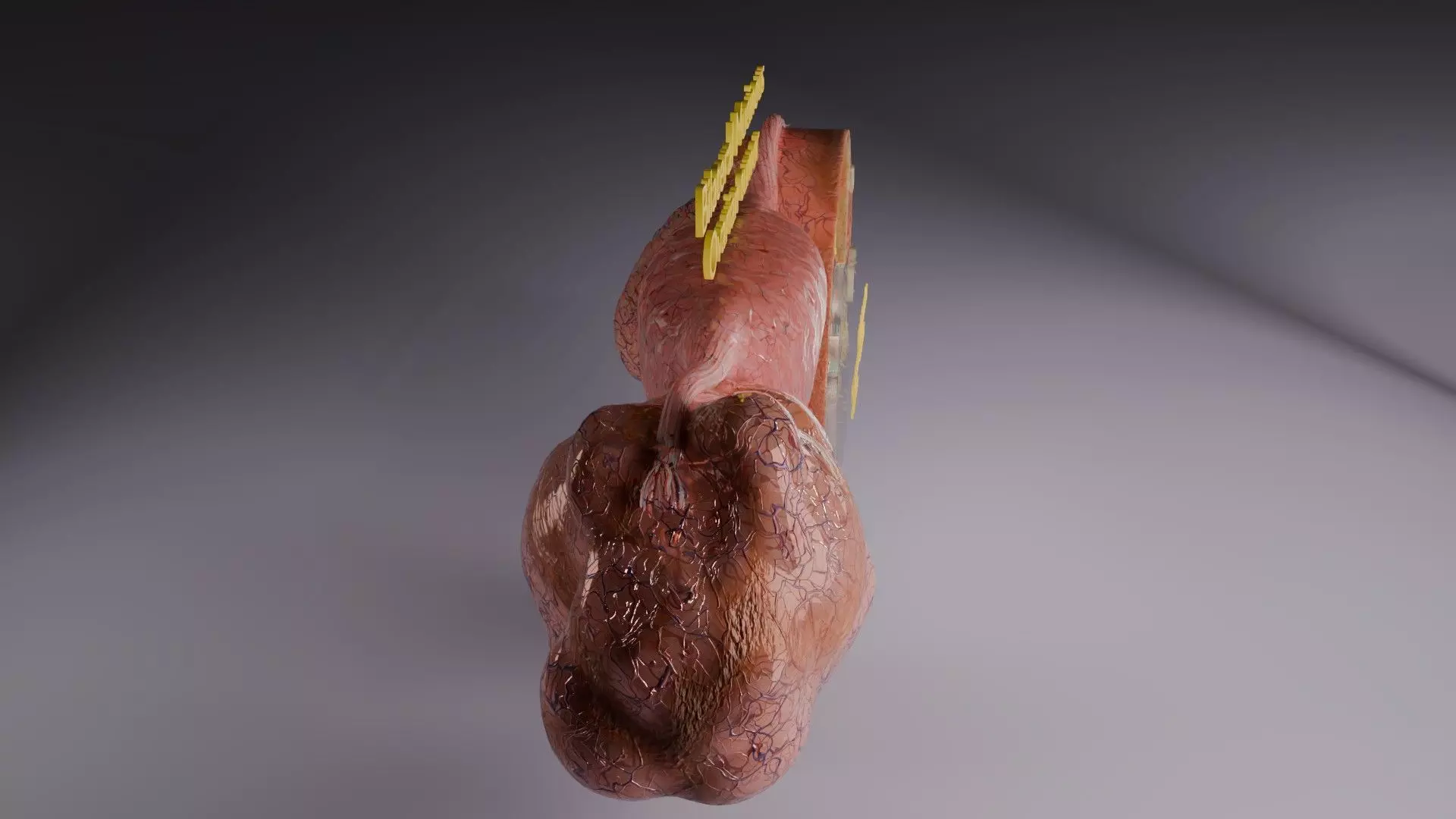 ovary mucinous cystic tumor  Low-poly 3D model_46