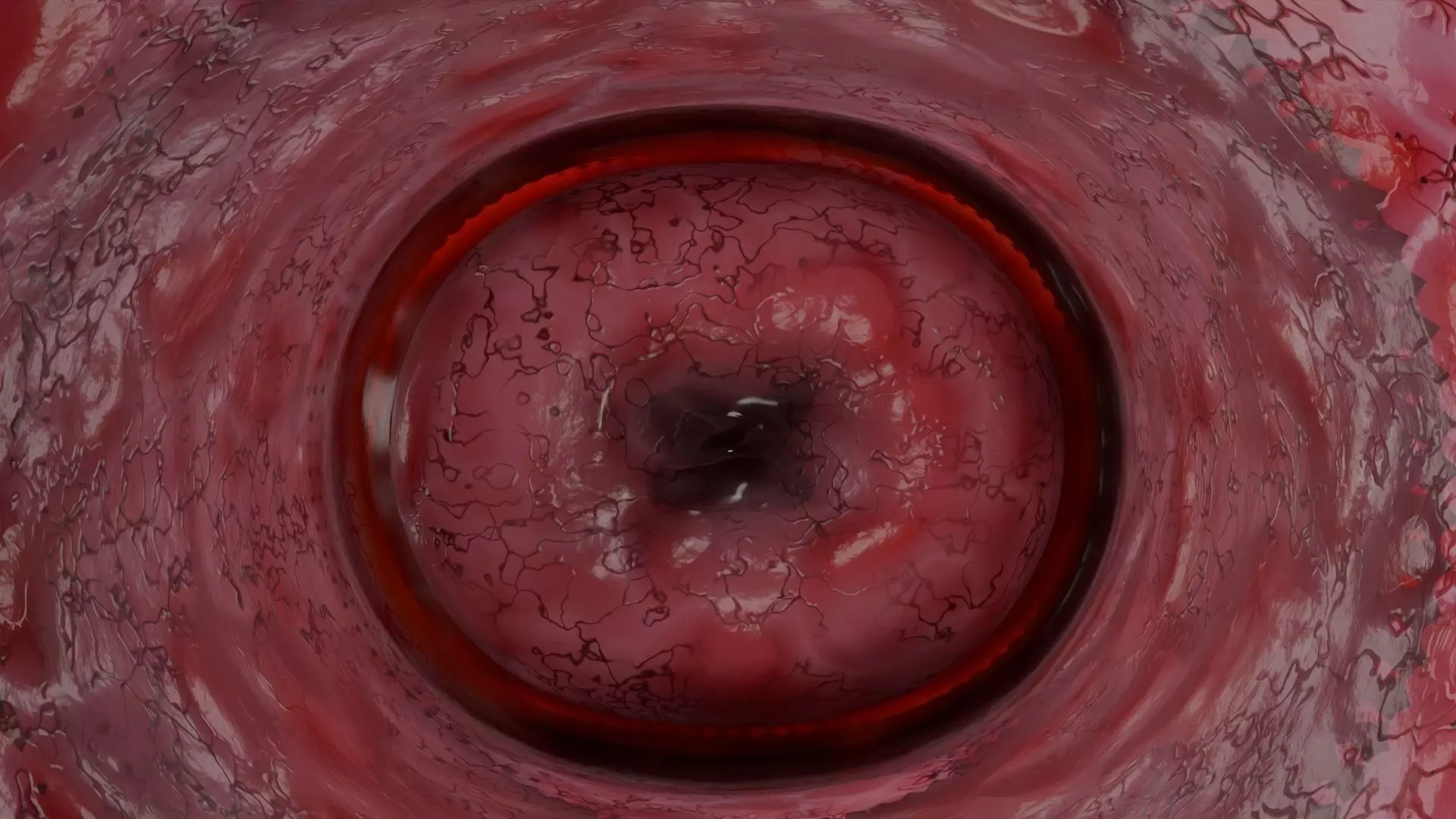 ovary mucinous cystic tumor  Low-poly 3D model_14