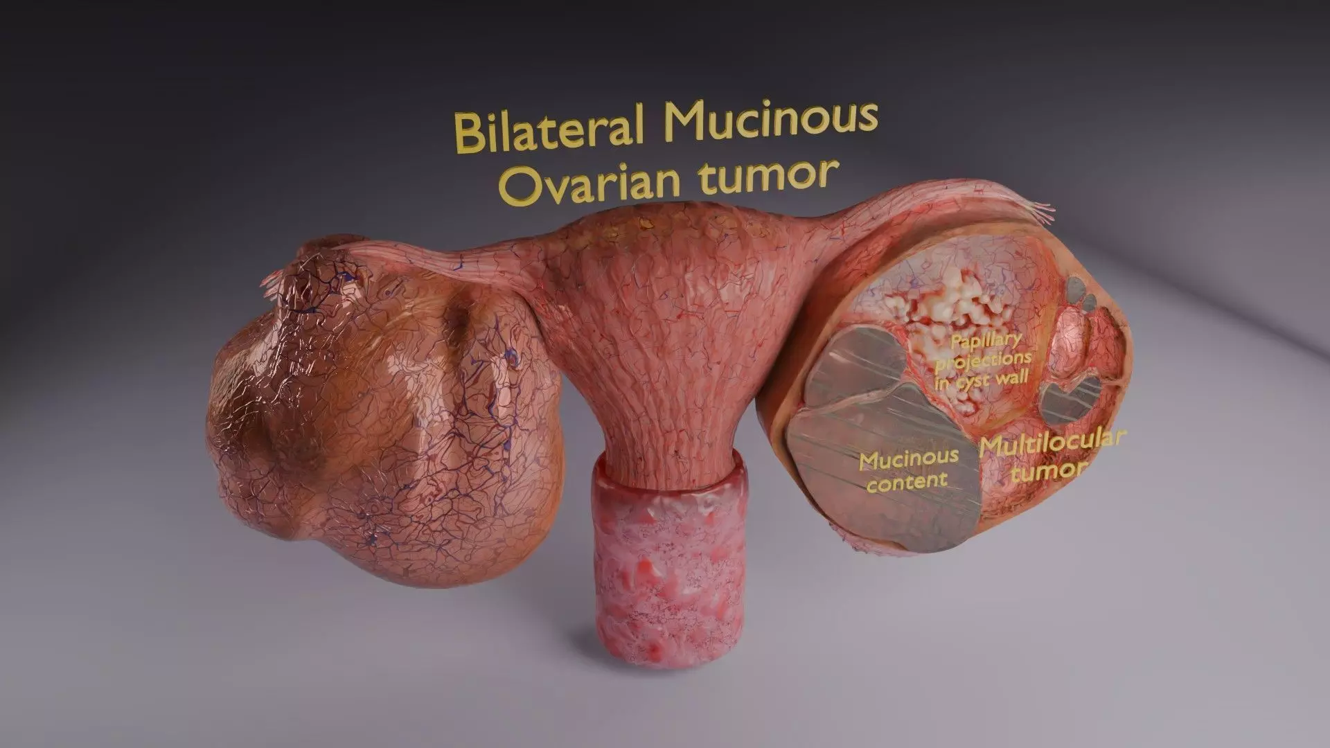 ovary mucinous cystic tumor  Low-poly 3D model_51