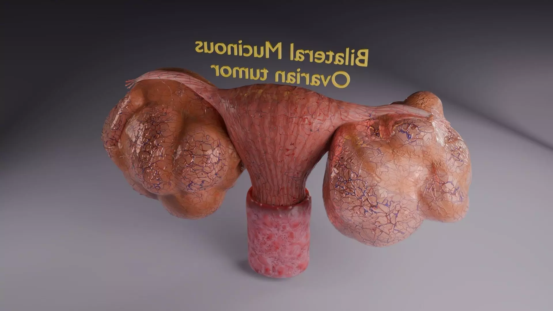 ovary mucinous cystic tumor  Low-poly 3D model_56