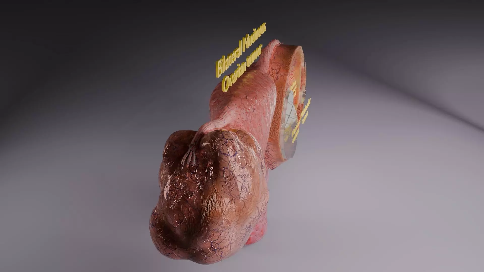 ovary mucinous cystic tumor  Low-poly 3D model_53