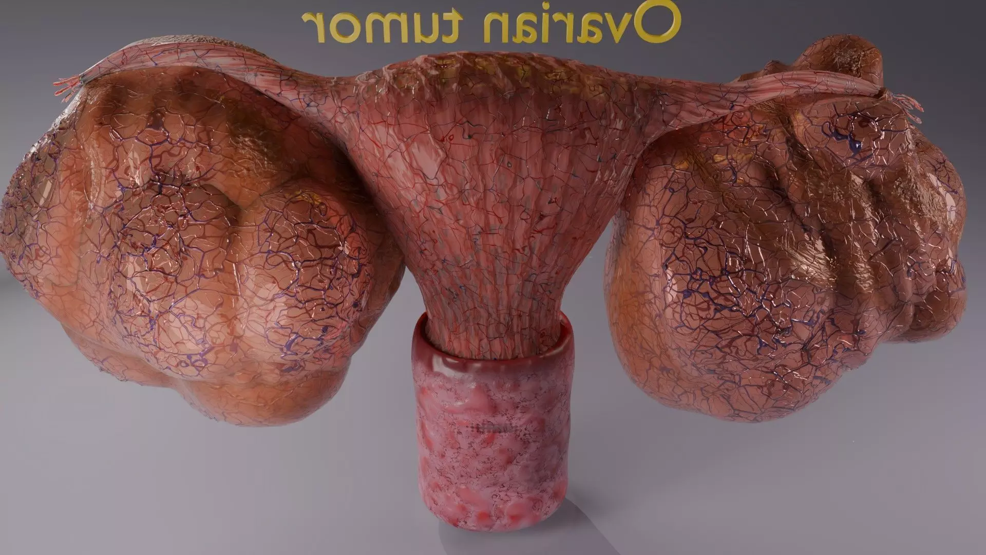 ovary mucinous cystic tumor  Low-poly 3D model_17