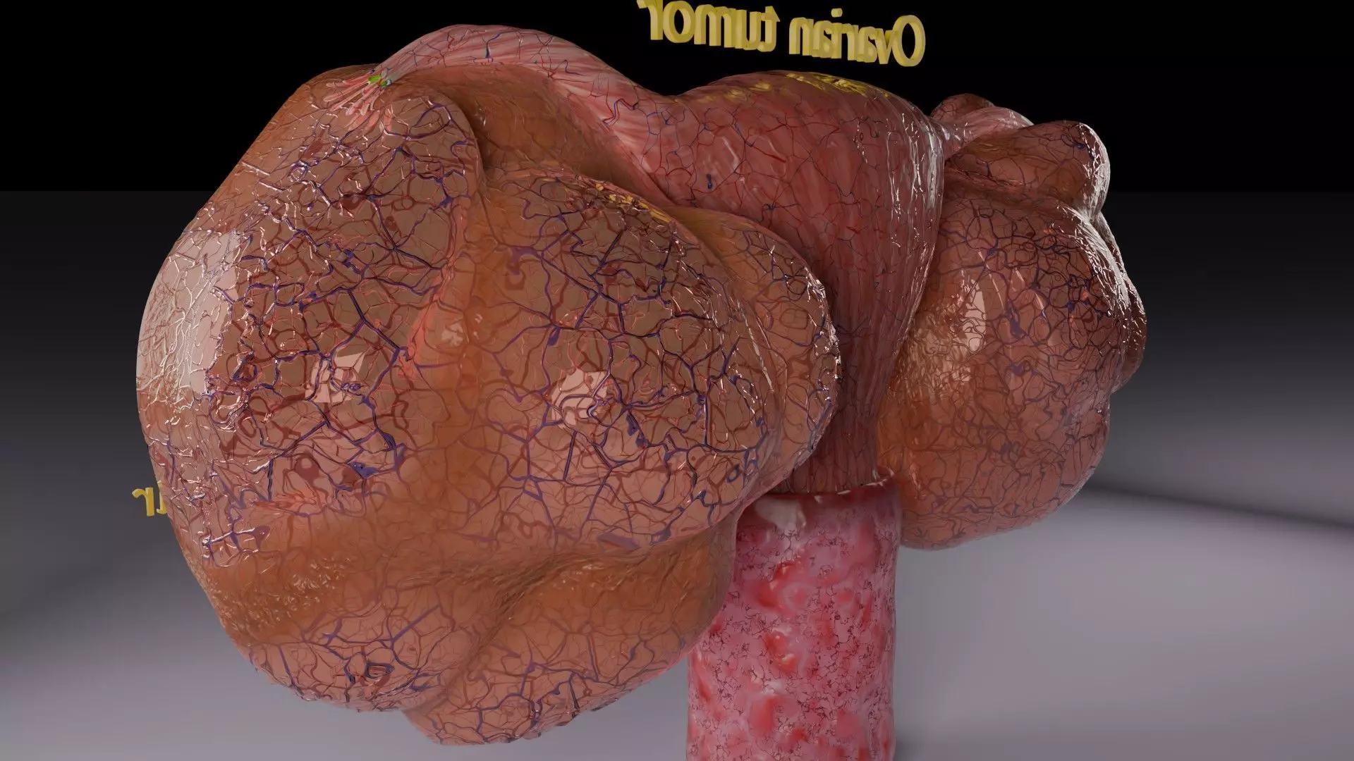 ovary mucinous cystic tumor  Low-poly 3D model_12